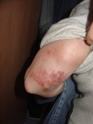 the bruise my aunt showed to me, lifting her jumper.